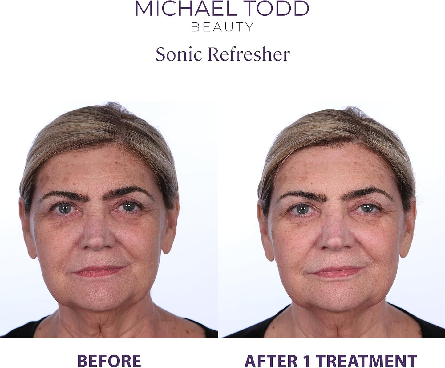 Beauty - Sonicrefresher - Wet/Dry Microdermabrasion & Pore Extraction System with Micromist Technology